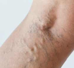 visszér hogyan lehet azonosítani a lábakon bőrkárosodás visszeres